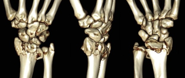 A True Guide to Distal Radius Fractures