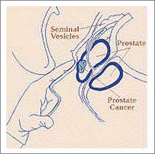 Symptoms of Prostate Cancer.jpg