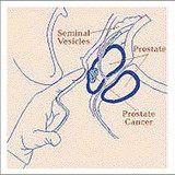 Symptoms of Prostate Cancer