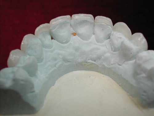Dental Veneers.jpg