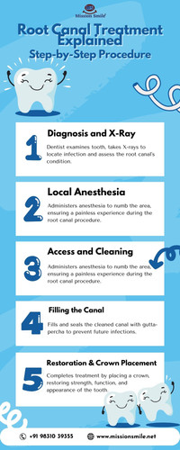 Root Canal Treatment Explained - Step-by-Step Procedure.jpg