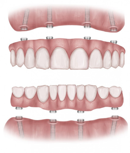 All On 4 Dental Implants.jpg