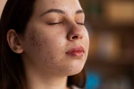 Effective Pigmentation Removal Treatment at Dermaura.jpg