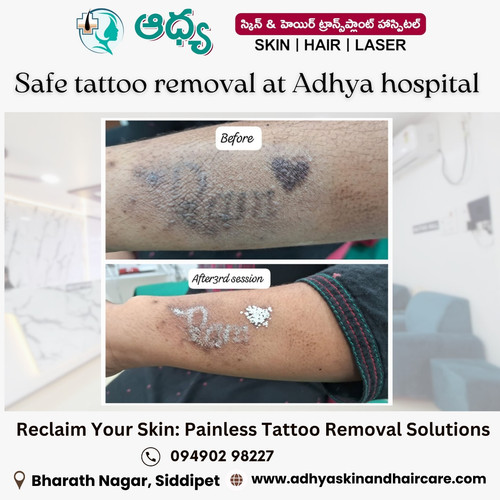 Laser Tattoo Removal in Siddipet