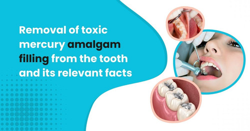 Removal of toxic mercury amalgam filling from the tooth and its relevant facts.jpg