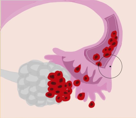 Ovarian Cancer.jpg