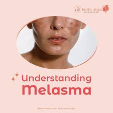 Effective Melasma Treatment in Hyderabad at Dermaura.jpg