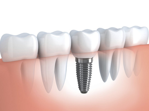 As a top-rated dental implants specialist in Nassau County & NYC. Philip M. Tornatore, DDS is recognized across Plainview and Hicksville for providing reliable dental implant treatment at the most competitive prices. They support individual artificial teeth, bridges, and also dentures. Book an appointment with him by contacting 516-931-5483 today! #Dental Implants Hicksville https://www.drphildds.com/dental-implants/