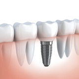 Dental Implants Hicksville - Dr Phil DDS