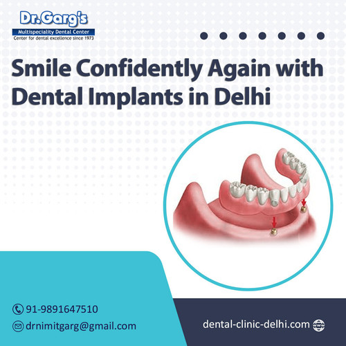 Smile Confidently Again with Dental Implants in Delhi.jpg