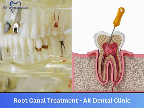 Trusted Root Canal Experts in Mumbai | AK Dental Clinic.jpg