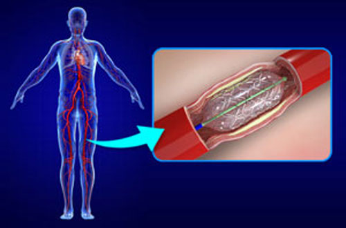 Angioplasty and Vascular.jpg
