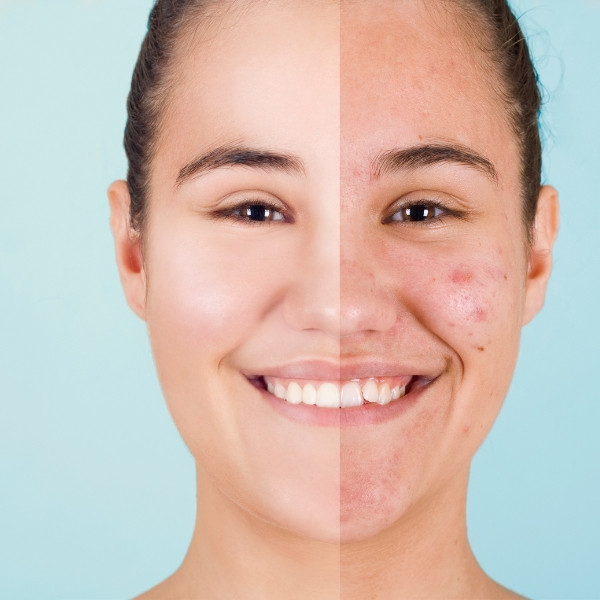 Skin Treatment 1