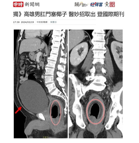 高雄男肛門塞椰子！醫妙招取出，登國際期刊！【中時】short.jpg