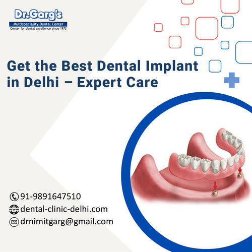 Get the Best Dental Implant in Delhi – Expert Care.jpg