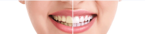 Teeth Whitening Treatment Nassau County - Dr Phil DDS.png
