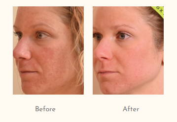 Skin Tightening Treatment in Mumbai.png