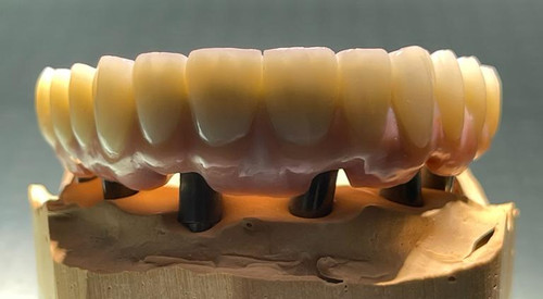 Dental implants Tijuana.jpg