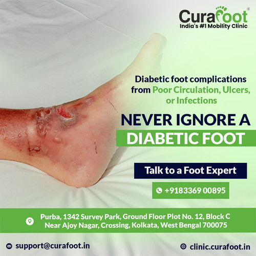 How to Spot the Early Symptoms of Diabetic Neuropathy in Your Feet.jpg