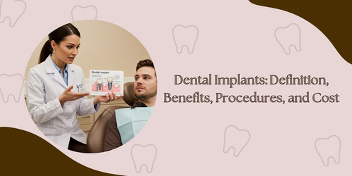 Dental Implants Definition, Benefits, Procedures, and Cost.jpg