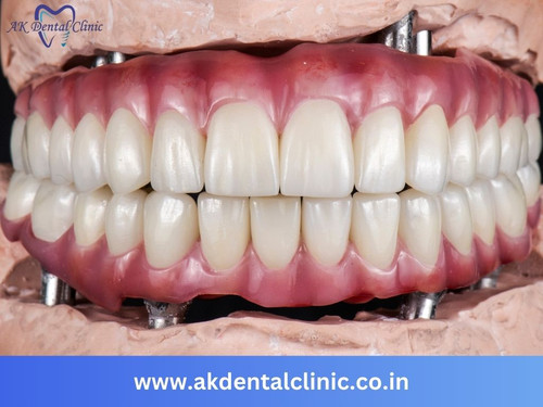 Dental Implants - AK Dental Clinic.jpg