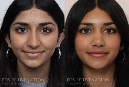Blepharoplasty Beverly Hills.jpg