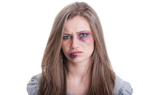 injured woman with bruised eye.jpg
