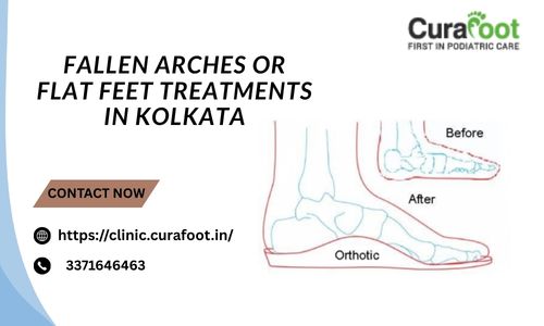 Effective Flat Feet Treatments by Expert Doctors in Kolkata.jpg