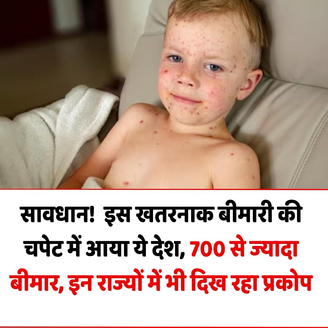 Measles Outbreak in USA: अमेरिका में खसरे का कहर, टेक्सास में 700 से ज्यादा लोग संक्रमित