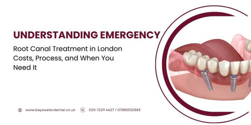 Understanding Emergency Root Canal Treatment in London.jpg