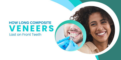 How Long Composite Veneers Last on Front Teeth.jpg