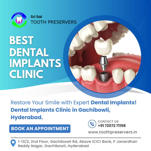 Dental Implants Clinic in Gachibowli Hyderabad.jpg