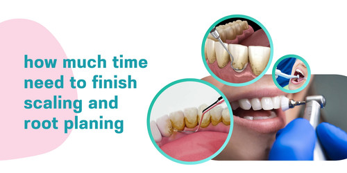 How Much Time Need To Finish Scaling And Root Planing.jpg