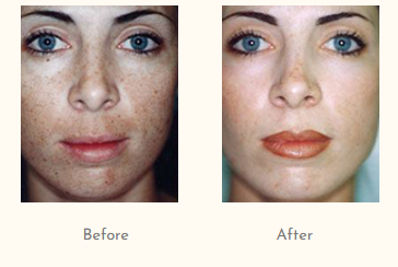 Peels Treatment (By Doctor Simple Aher).png