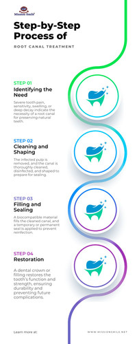 Step-by-Step Process of Root Canal Treatment.jpg