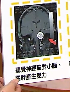 聽神經瘤.jpg