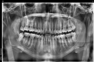 Wisdom teeth removal Tijuana.jpg