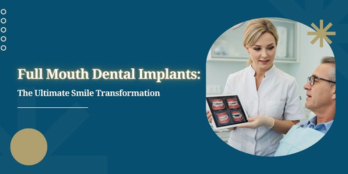 Full Mouth Dental Implants The Ultimate Smile Transformation.jpg