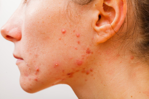 tudo sobre a acne como tratar e prevenir o problema 20181106105214 1.jpg 1.jpg