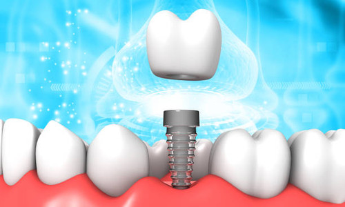 Cost of Dental Implants in Santa Clarita.jpg