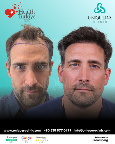 DHI Hair Replacement – Uniquera Clinic Turkey.jpg