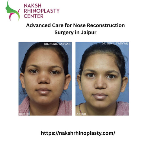 Advanced Care for Nose Reconstruction Surgery in Jaipur.jpg