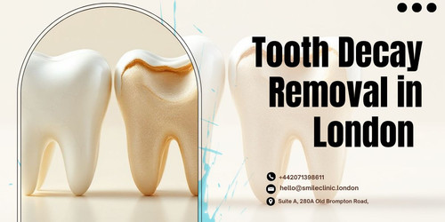 Professional Tooth Decay Removal in London Today.jpg