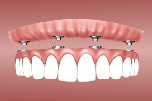 All-On-X Dental Implants Melbourne.png