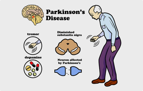 Parkinson's Disease Treatment in Singapore Zhao Neurology.jpg