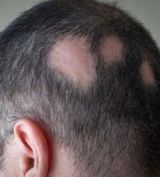 Alopecia Areata Treatment in Ghaziabad.1