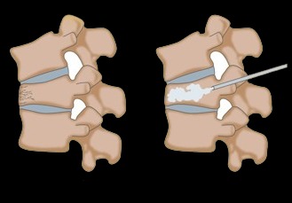 VerteboplastyKyphoplasty Doctor in Indore.jpg