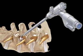 Spine Endoscopy in Indore.jpg