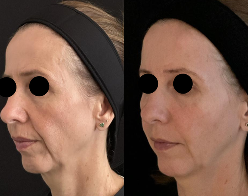 before after 4 Cymz y6q.png