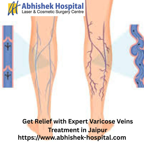 Get Relief with Expert Varicose Veins Treatment in Jaipur (1).jpg